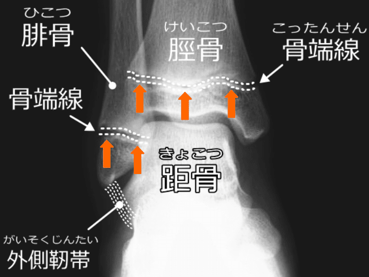 足首の捻挫(足関節腓骨遠位骨端線離開) - Piece 海外留学サポート